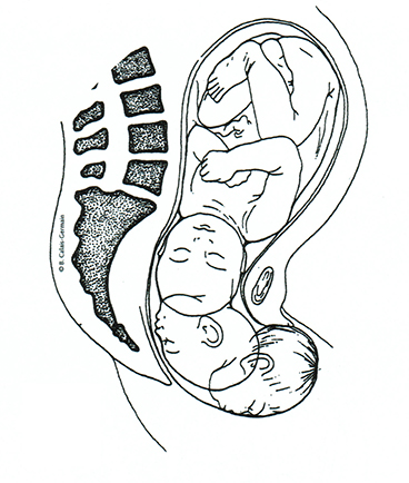 Schematische Darstellung einer Geburt